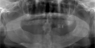 case1のＣＴ画像手術後