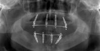 case1のＣＴ画像手術前