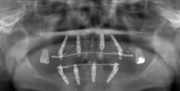 case1のＣＴ画像手術後