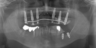 case3のＣＴ画像手術後