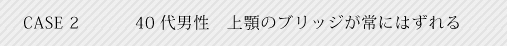 case2 40代男性上顎のブリッジが常にはずれる