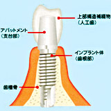 インプラント